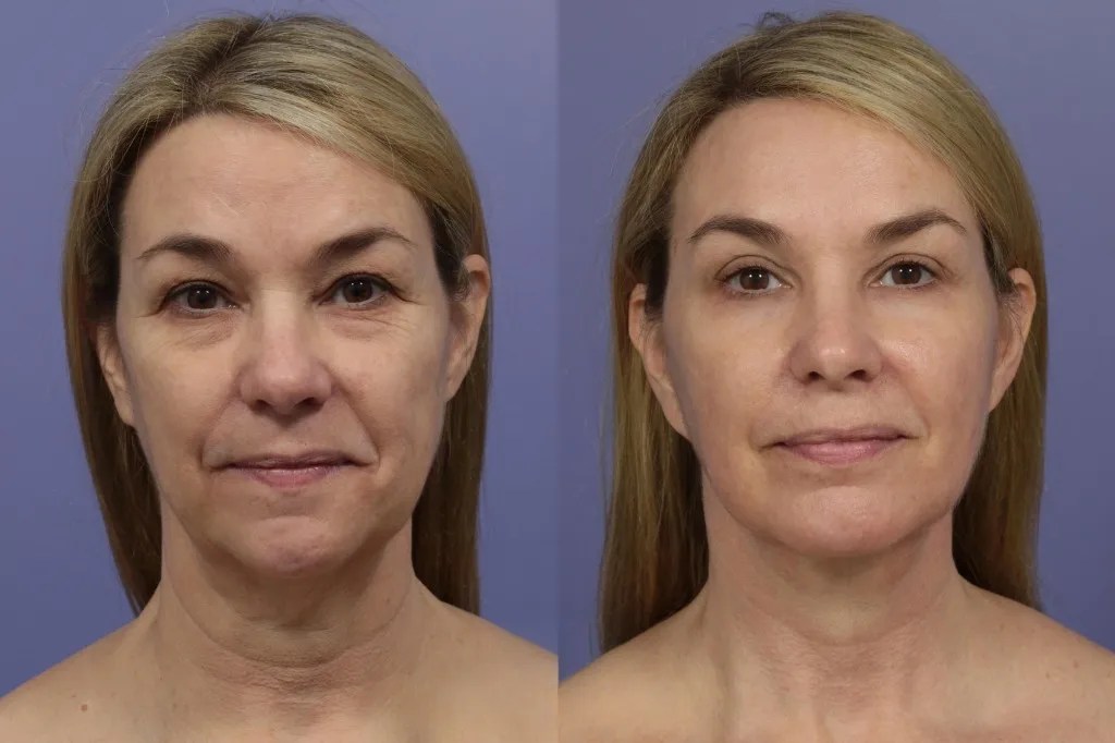 Best NCTF 135HA Skin Treatment in Dubai