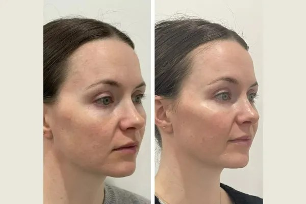NCTF Treatment for Skin Rejuvenation in Dubai
