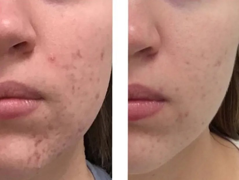 SaltFacial Skin Exfoliation Treatment Dubai