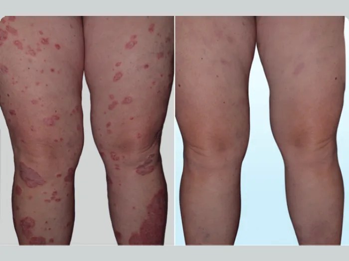 Safe Rash Removal Treatment Dubai