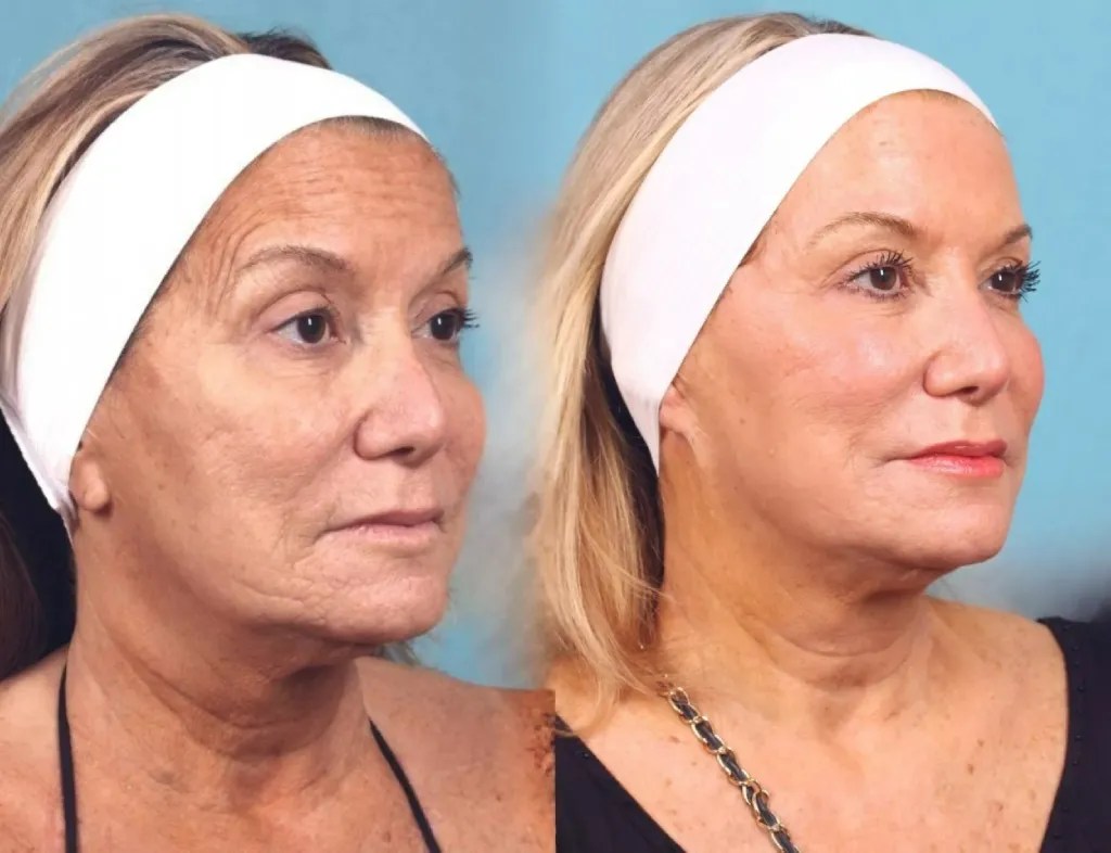 Ultherapy Non-Surgical Facelift Dubai