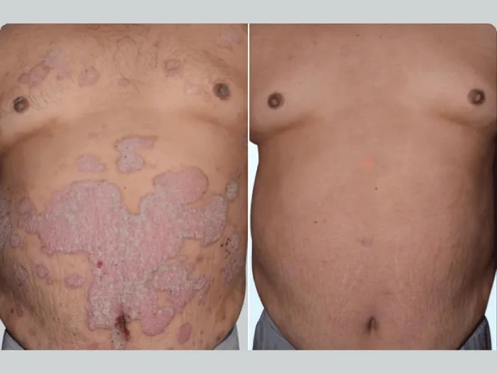 Advanced Therapy for Skin Rash Abu Dhabi