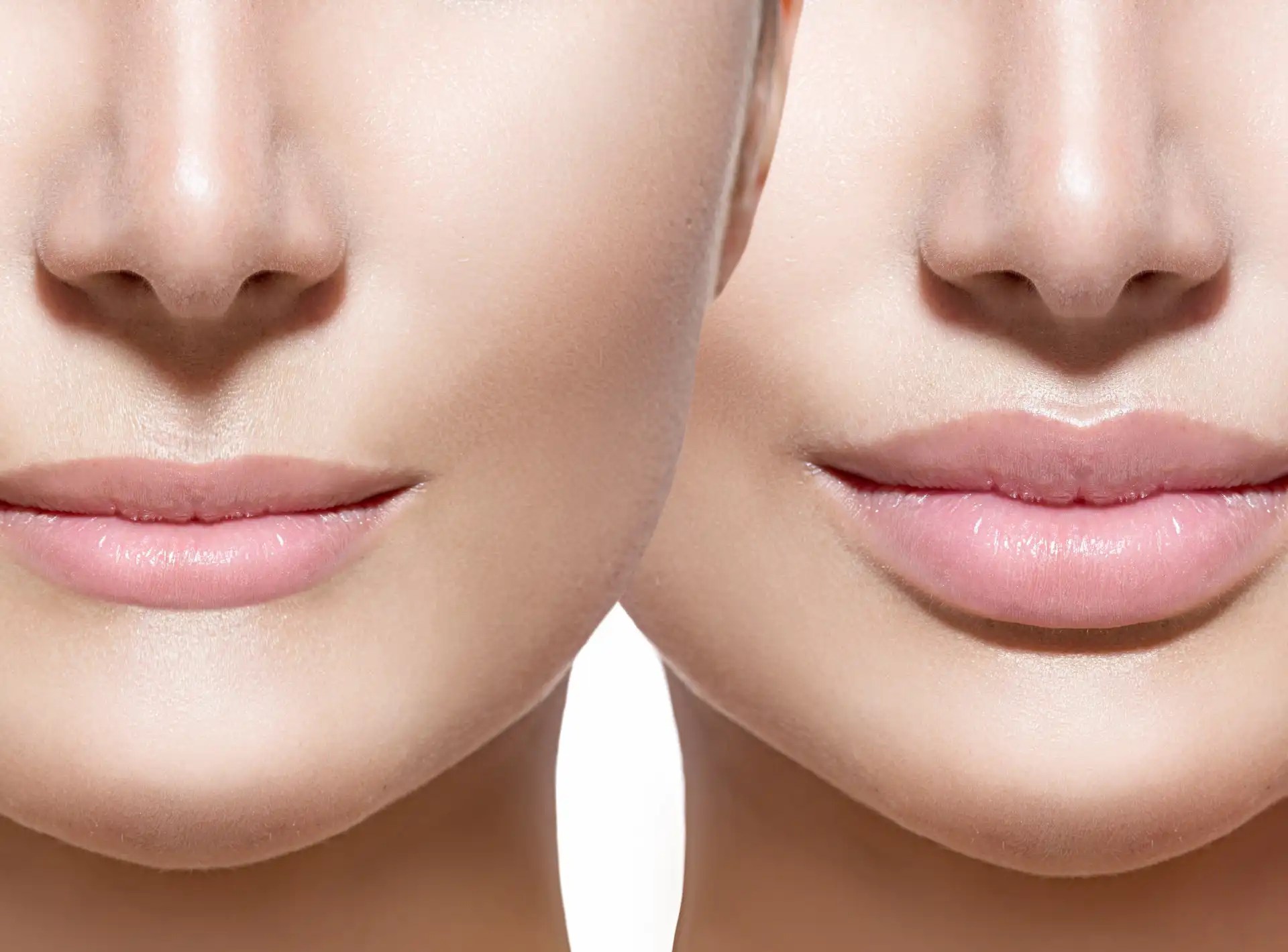 Lip Fillers In Dubai
