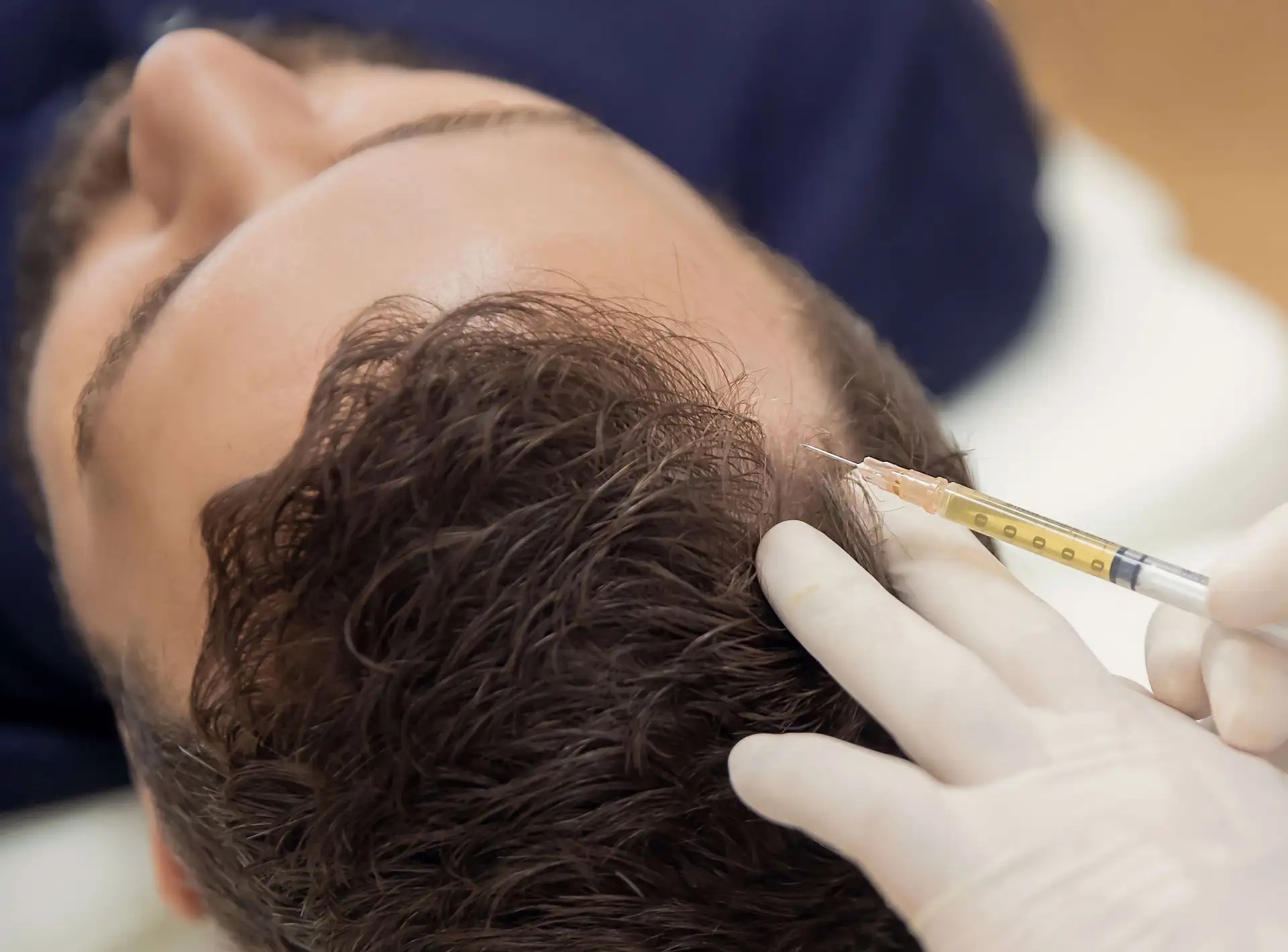 PRP Treatment In Dubai