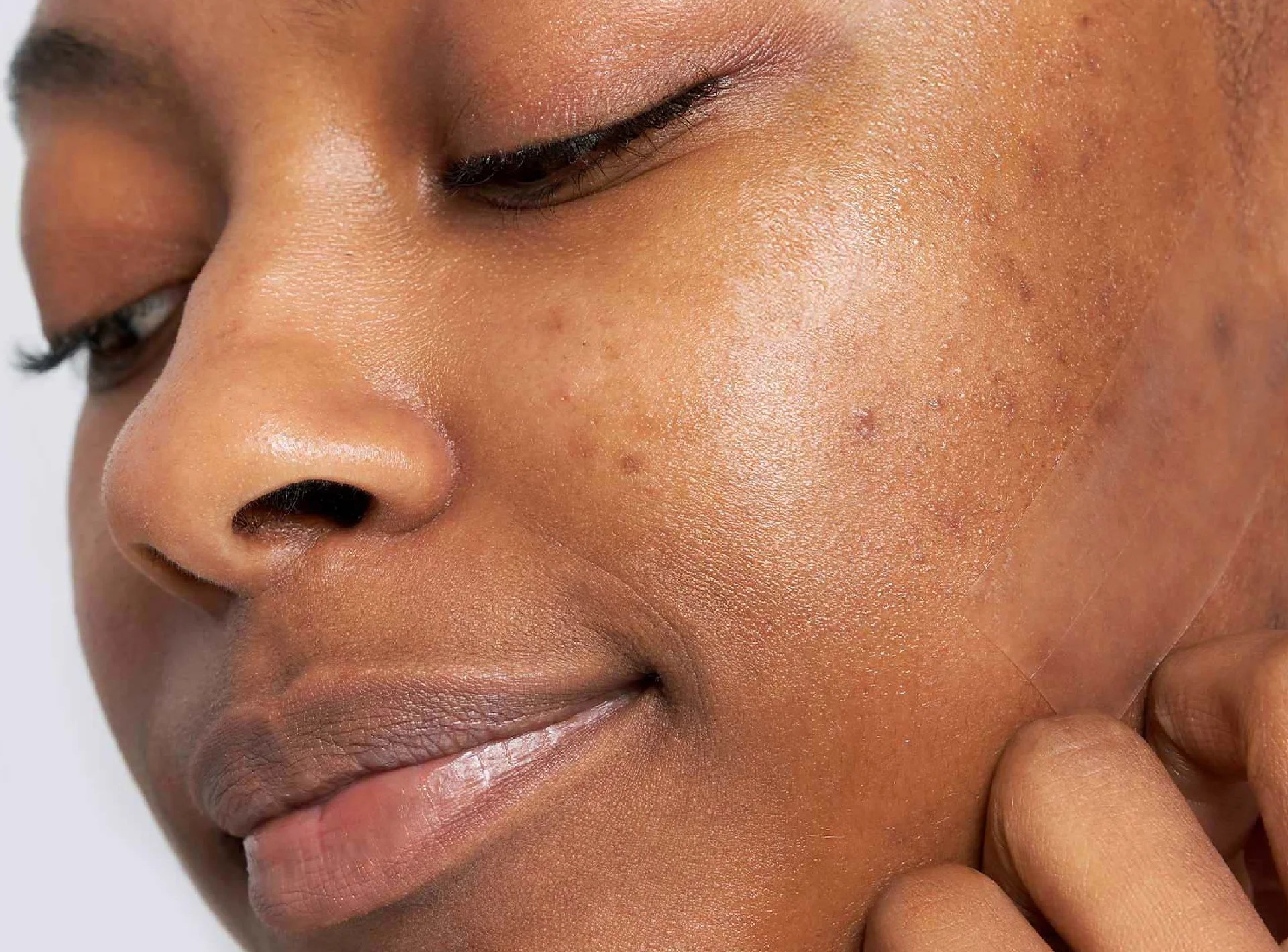 Why Do Acne Scars Look Worse Over Time?