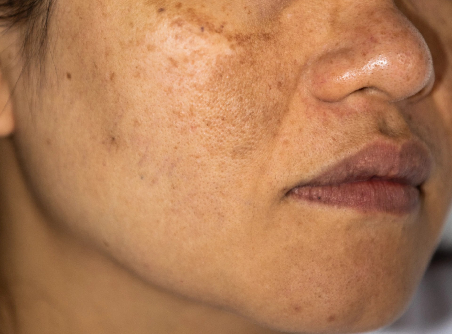 Remove Pigmentation from Face Permanently