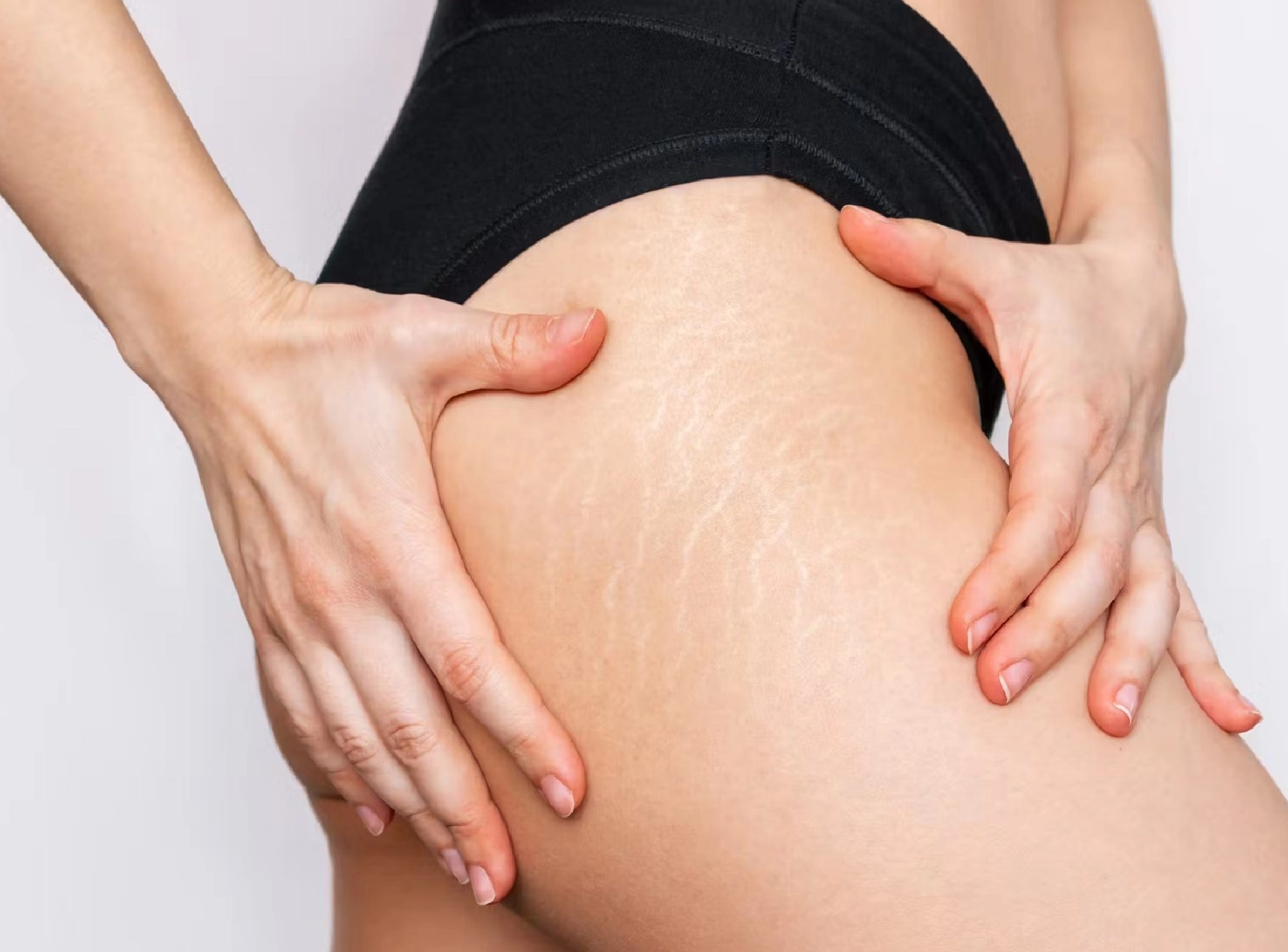 What Are Stretch Marks