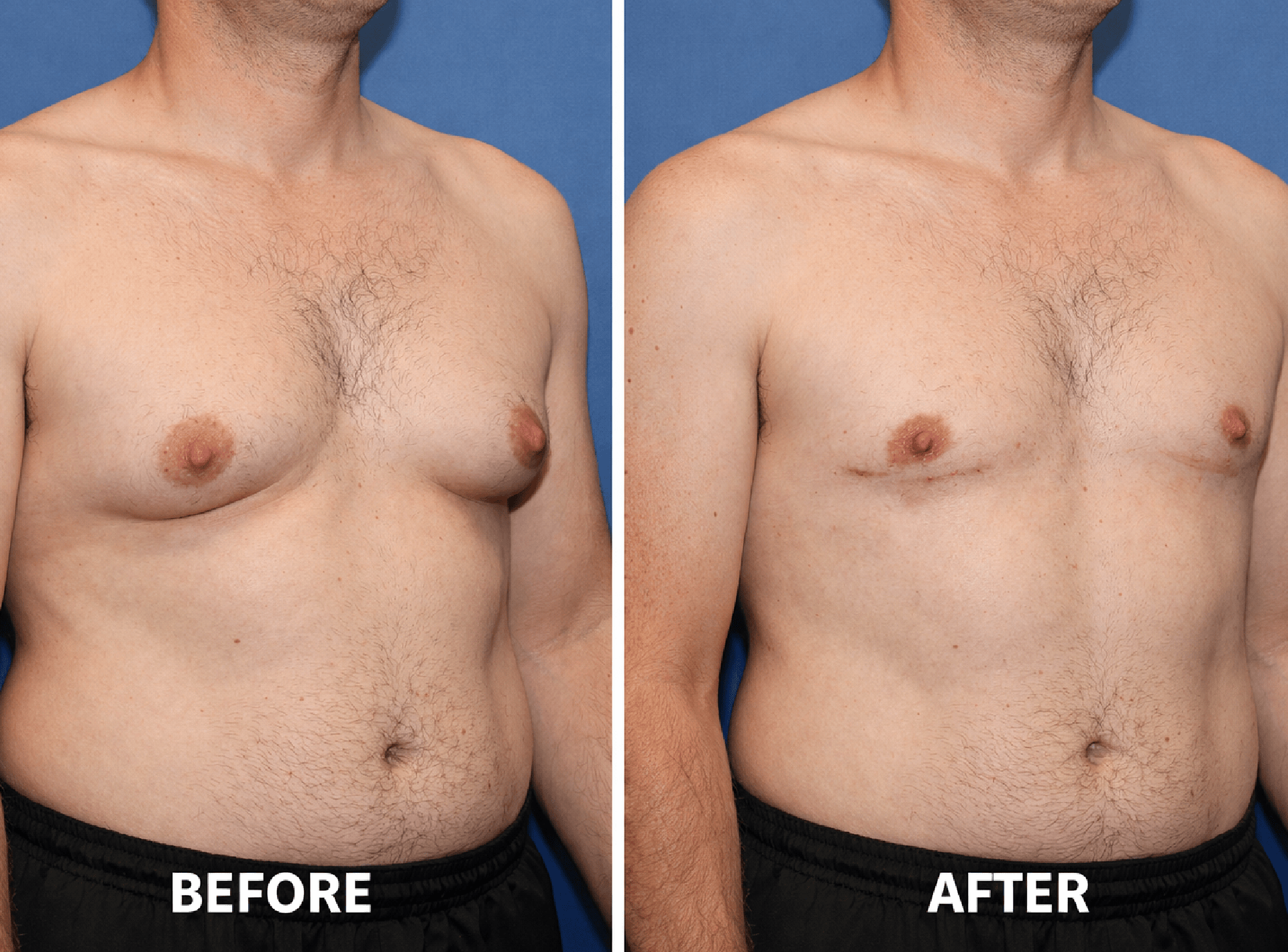 Blood Test For Gynecomastia