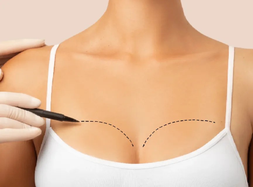 Breast Lift Recovery: Tips + What to Expect