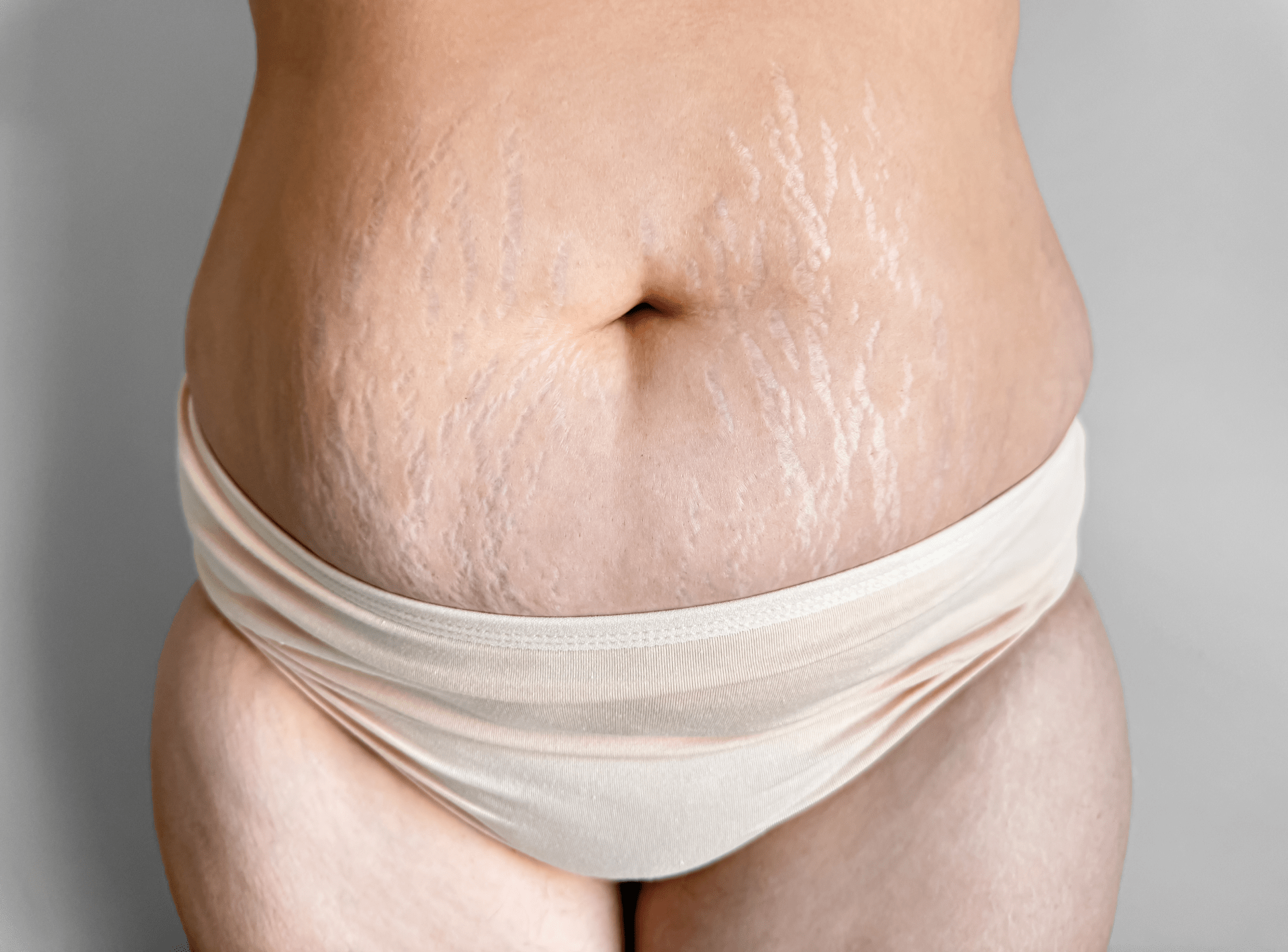 Which Treatment Is Best For Removing Stretch Marks?