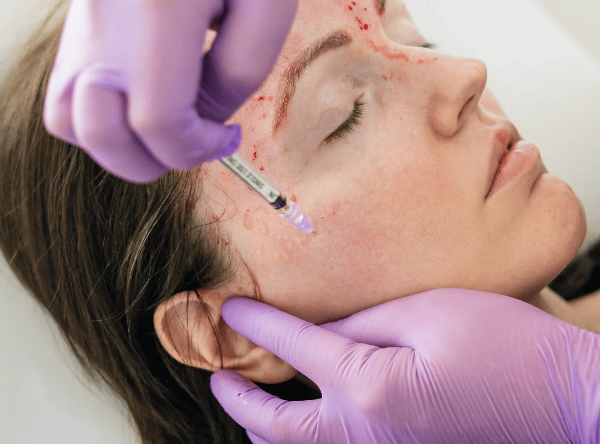 Are Vampire Facials® Safe?