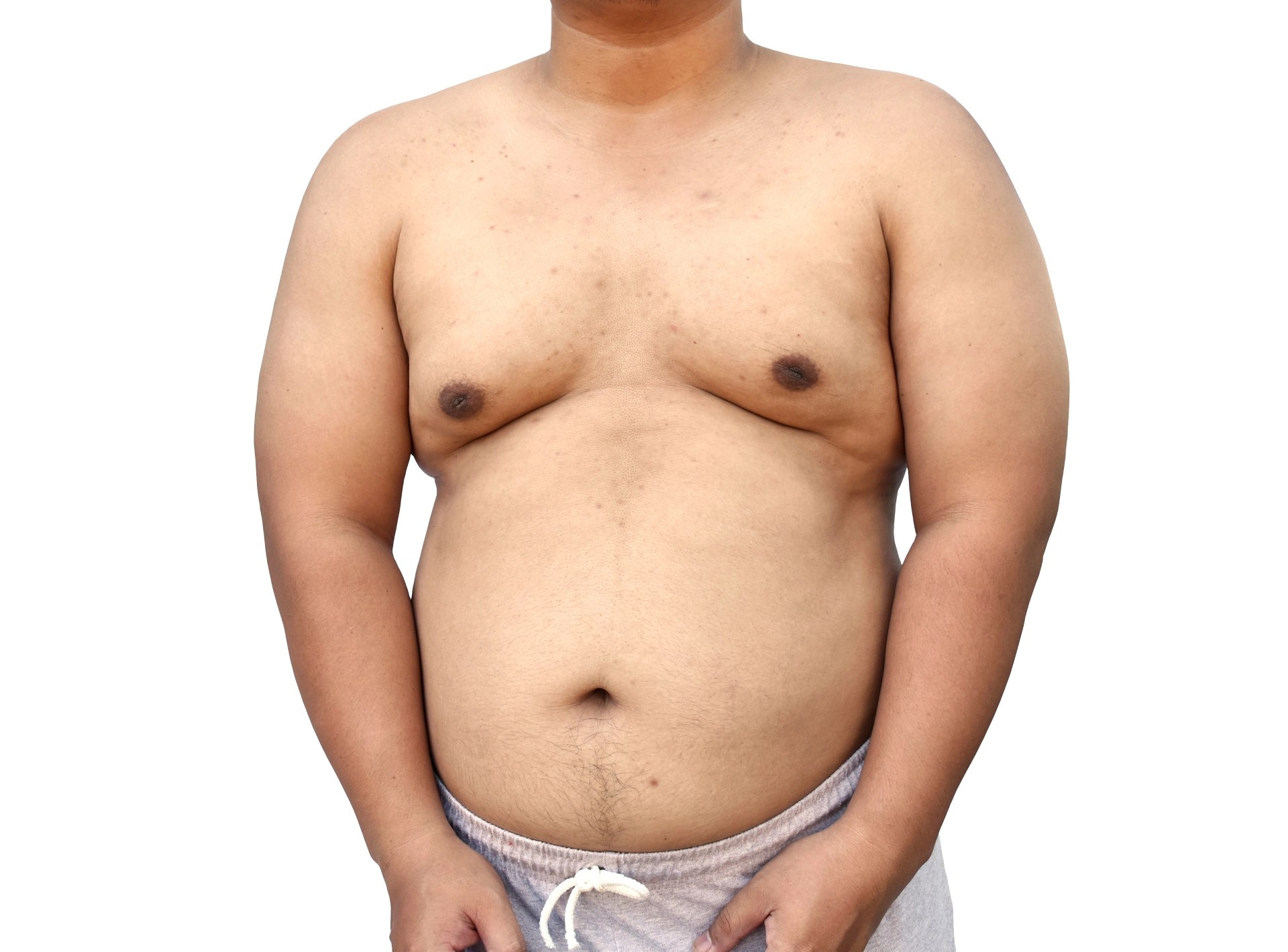 Does Vaping Cause Gynecomastia?
