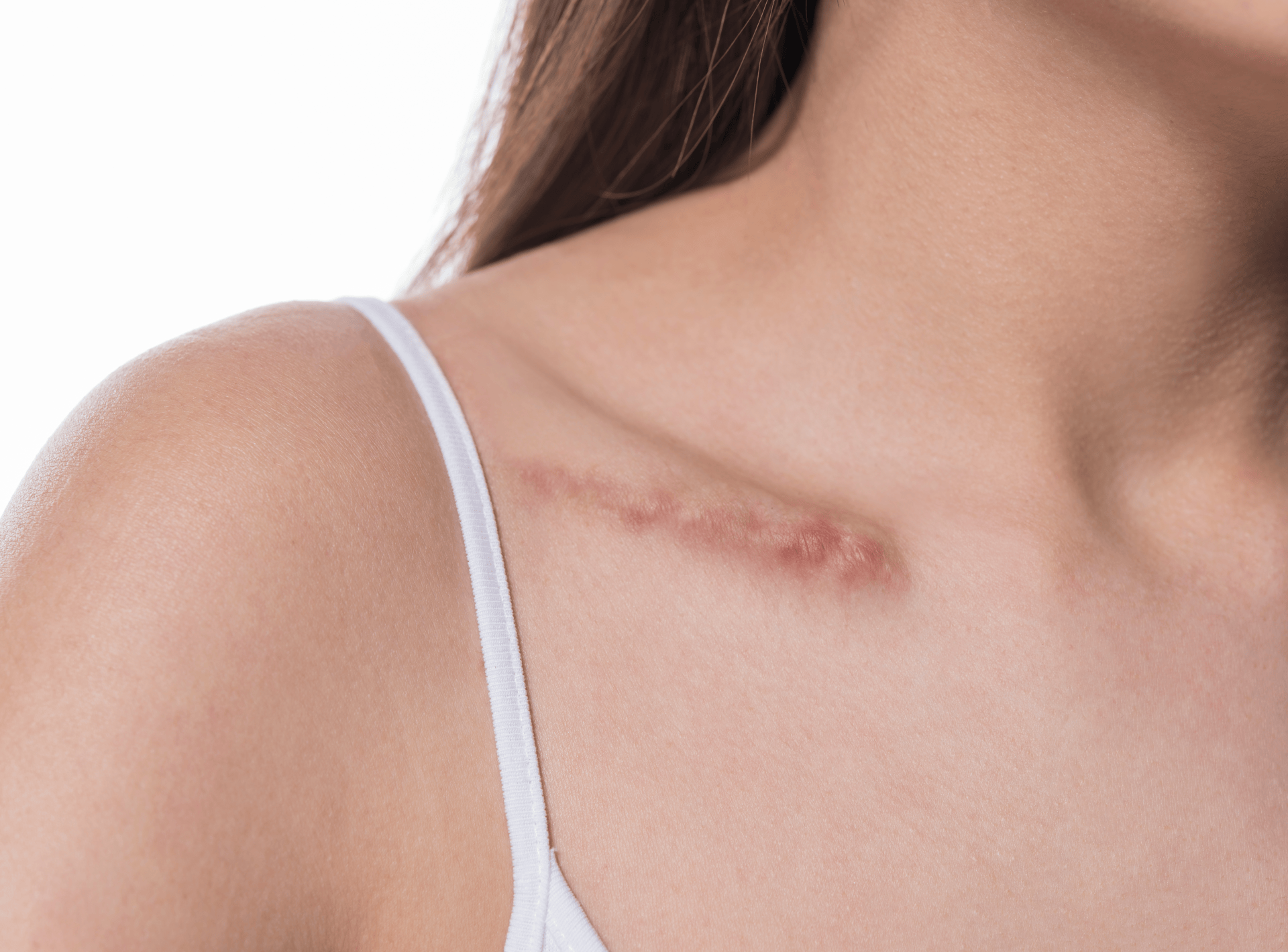Does Skin Tone Or Type Affect Scar Revision Results?