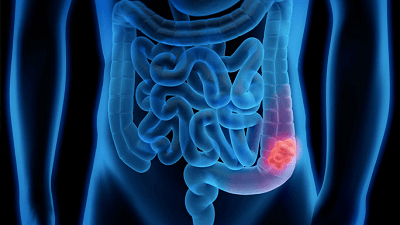 Understanding Colorectal Cancer Symptoms Diagnosis And Treatment - Stunning Light Texture - HD