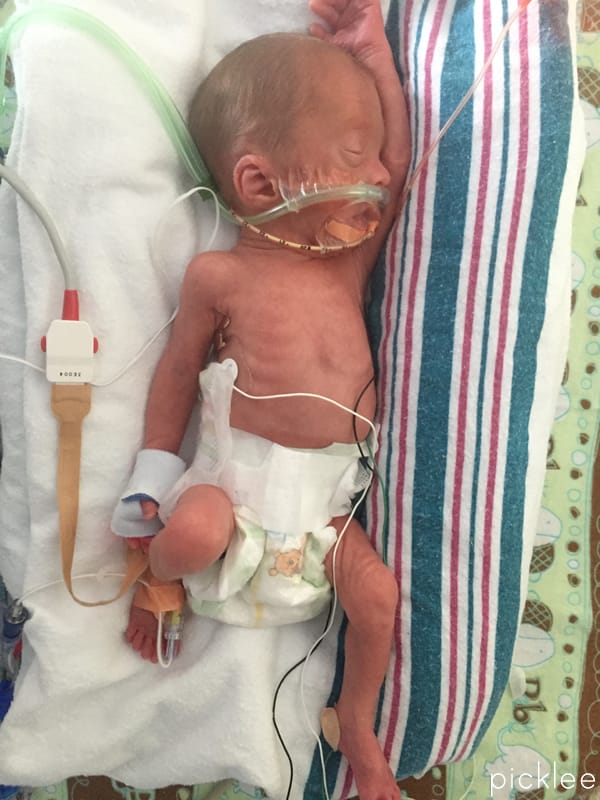 Baby born at 28 weeks