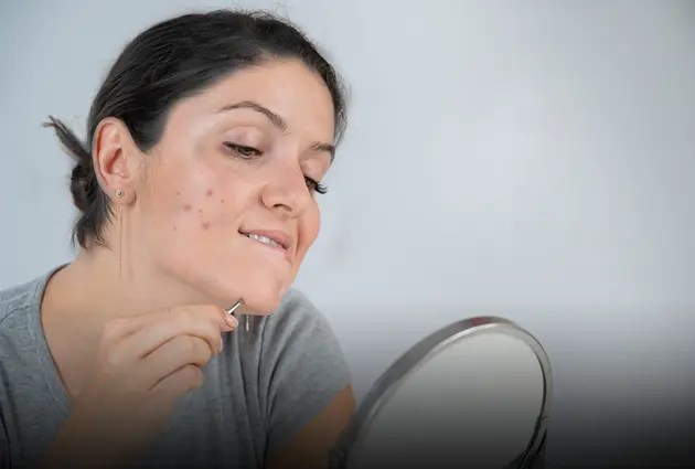The underlying reason behind acne & hirsutism