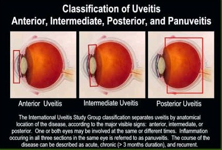 A total of 75 eyes of 72 patients with a mean age of 38.6±15.1. Uveitis Ranu Eye Specialist In Puchong