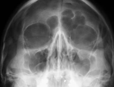 Enter search terms and tap the search button. Zygomatic Complex And Nasal Injury Rcemlearning