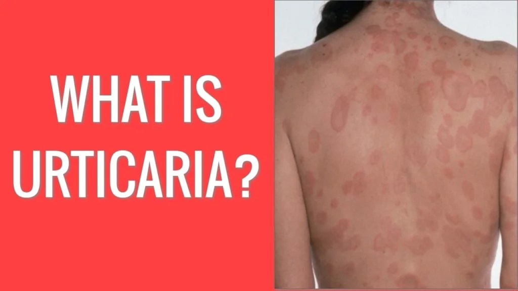 What Is Hives Health Solutions