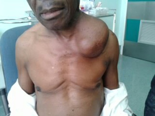 Se trata de una tumefacción indolora, blanda, de tamaño variable, abollonada, de límites mal definidos. NÃ³dulo de Virchow gigante como presentaciÃ³n inicial de un