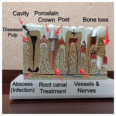 After each appointment when anesthetic has been used, your lips, teeth and tongue may be numb for . Root Canal Therapy Ridgeplex Dental Care