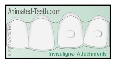 Invisalign update: removing attachments and assessing the treatment