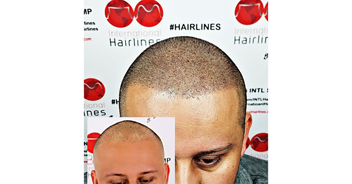scalp micropigmentation that looks like real hair