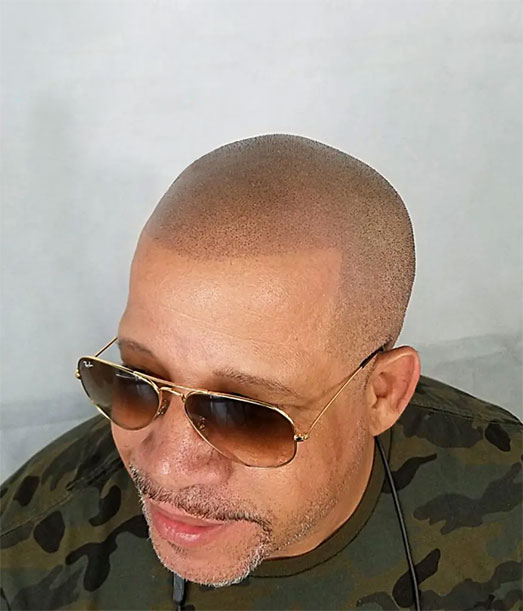 scalp micropigmentation client TESTIMONIALS