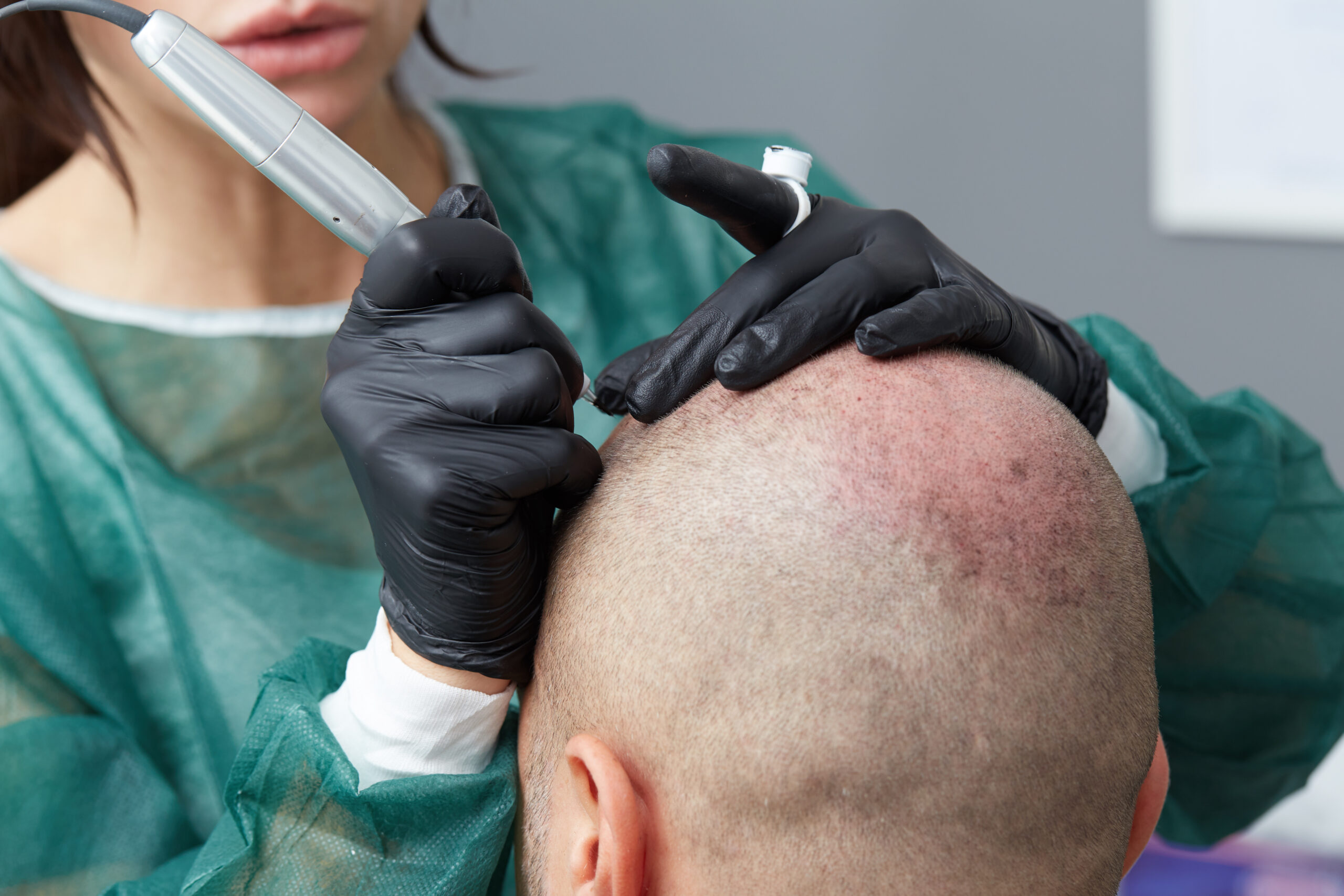 Scalp Micropigmentation Procedure