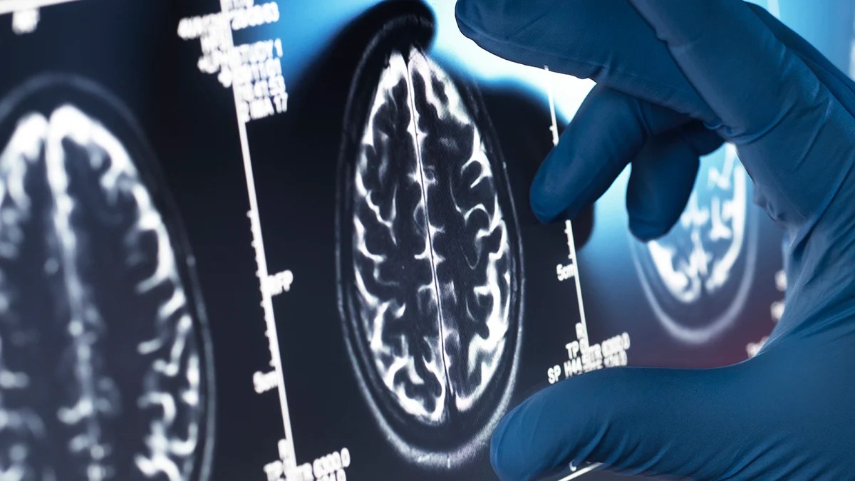 Viagra for Alzheimer's? Experts Say It's a Top Contender - Here's Why (2026)
