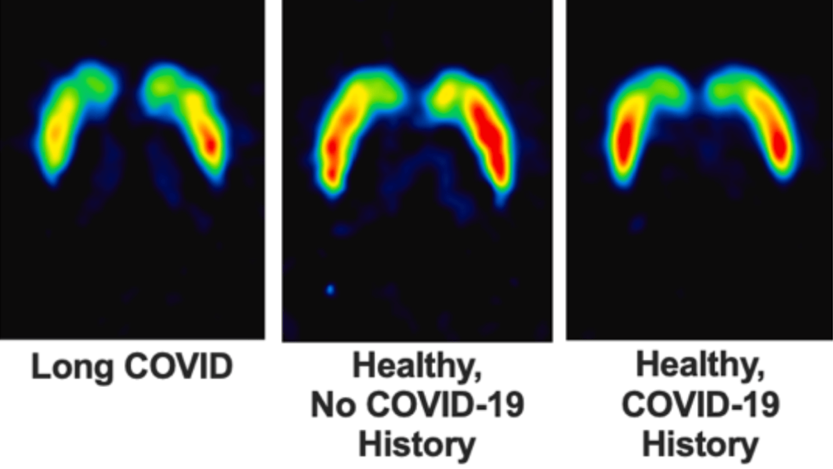 Long COVID's Hidden Brain Damage: Dopamine System Under Attack (2026)