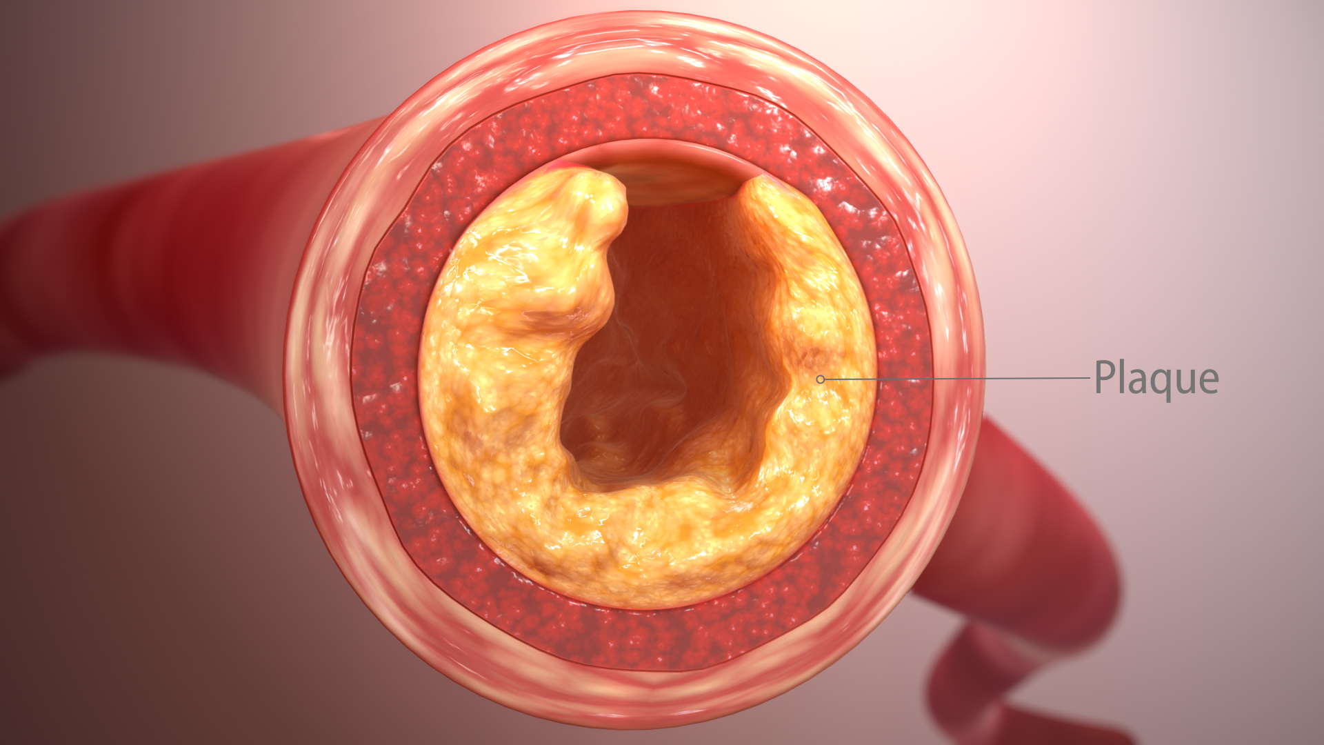 images Real Pictures Of Clogged Arteries scientific animations