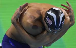 cupping