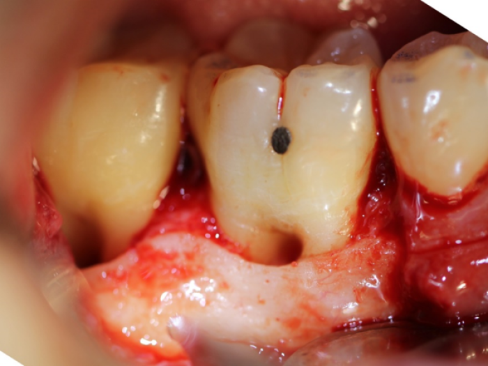SteinerBio™ The Periosteum for Regenerating Periodontal Lesions