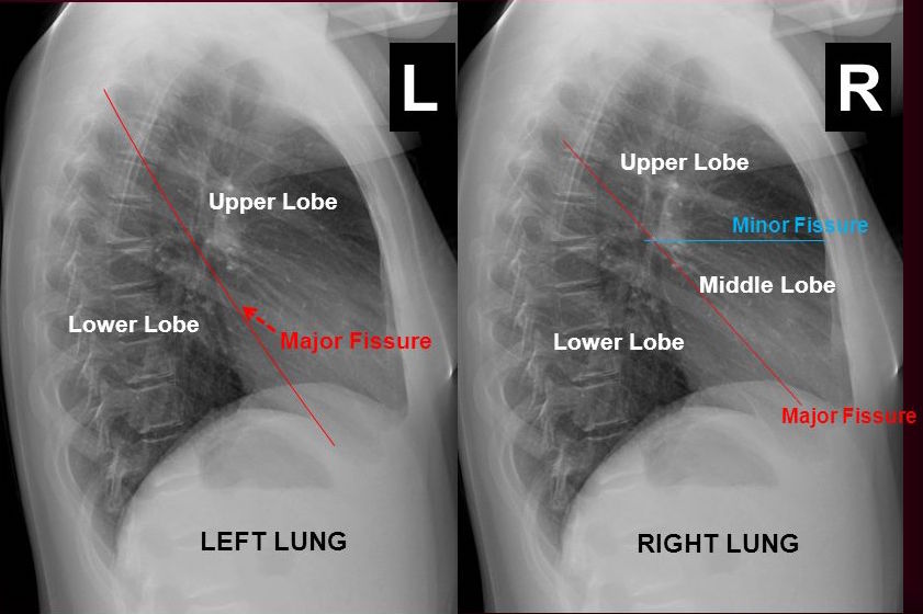 Here's what to expect with this painless procedure and why your dentist may recommend it. Interpreting A Chest X Ray Stepwards