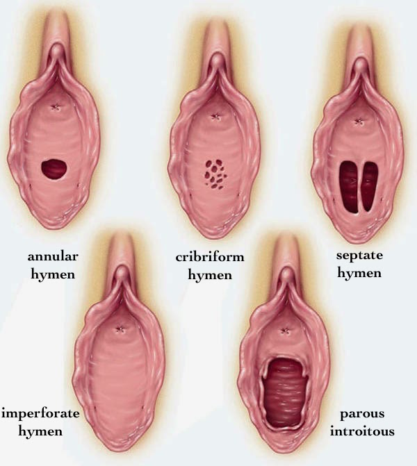 Imperforate hymen repair