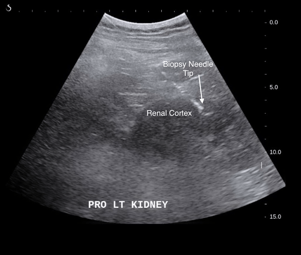 Interventional Radiology Procedures Ultrasound Guided NonFocal Renal Biopsy Stepwards
