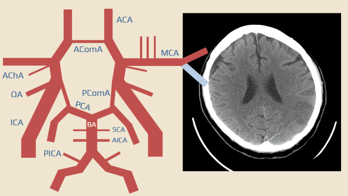 Topical diagnosis of stroke | STROKE MANUAL Topical diagnosis of stroke | STROKE MANUAL