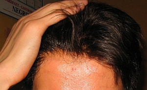 Le design de ligne frontale est le facteur déterminant l'apparence naturelle du résultat final de la greffe de cheveux et par conséquent de la réussite de . Remplacement total : photos ligne frontale "avant / aprÃ¨s"