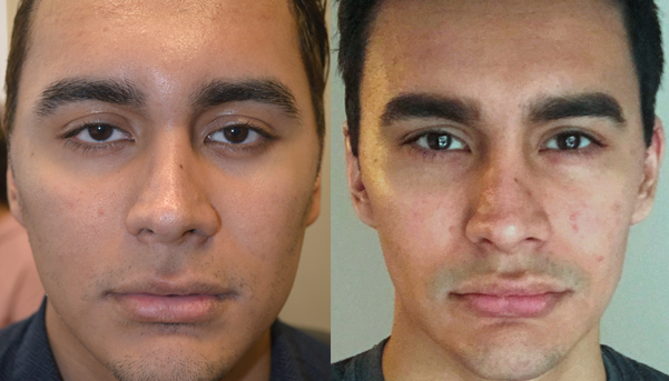 What the enchroma glasses do is increase color contrast. Eight | Taban MD oculoplastic cosmetic eyelid plastic