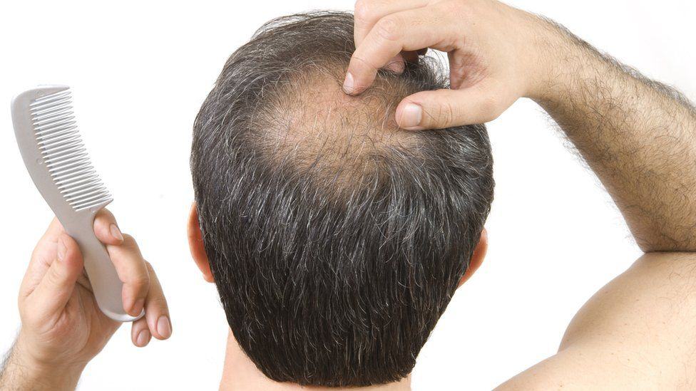 Minoxidil; the Topical Magic Treatment