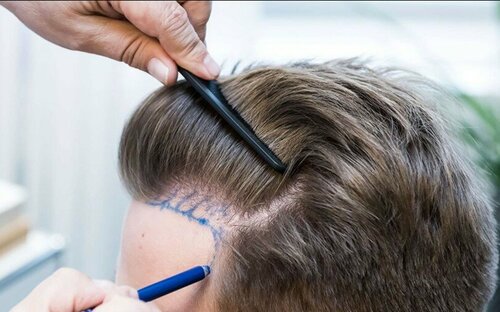Preparing for Your Hair Transplant Procedure in Riyadh