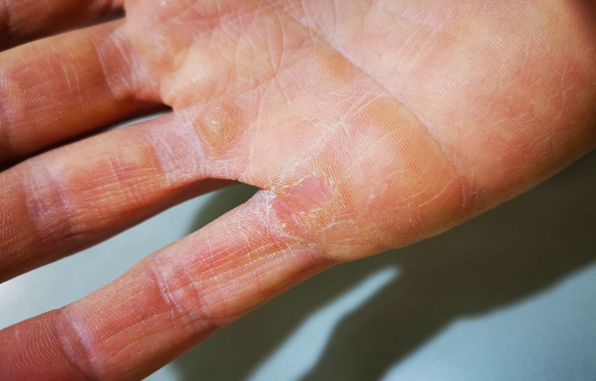 How To Get Rid Of Calluses On Hands