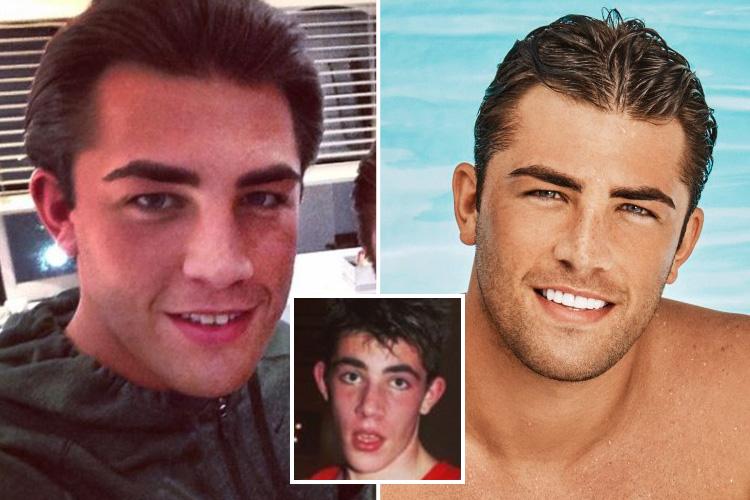 pic Jordan Love Island Teeth Before the sun