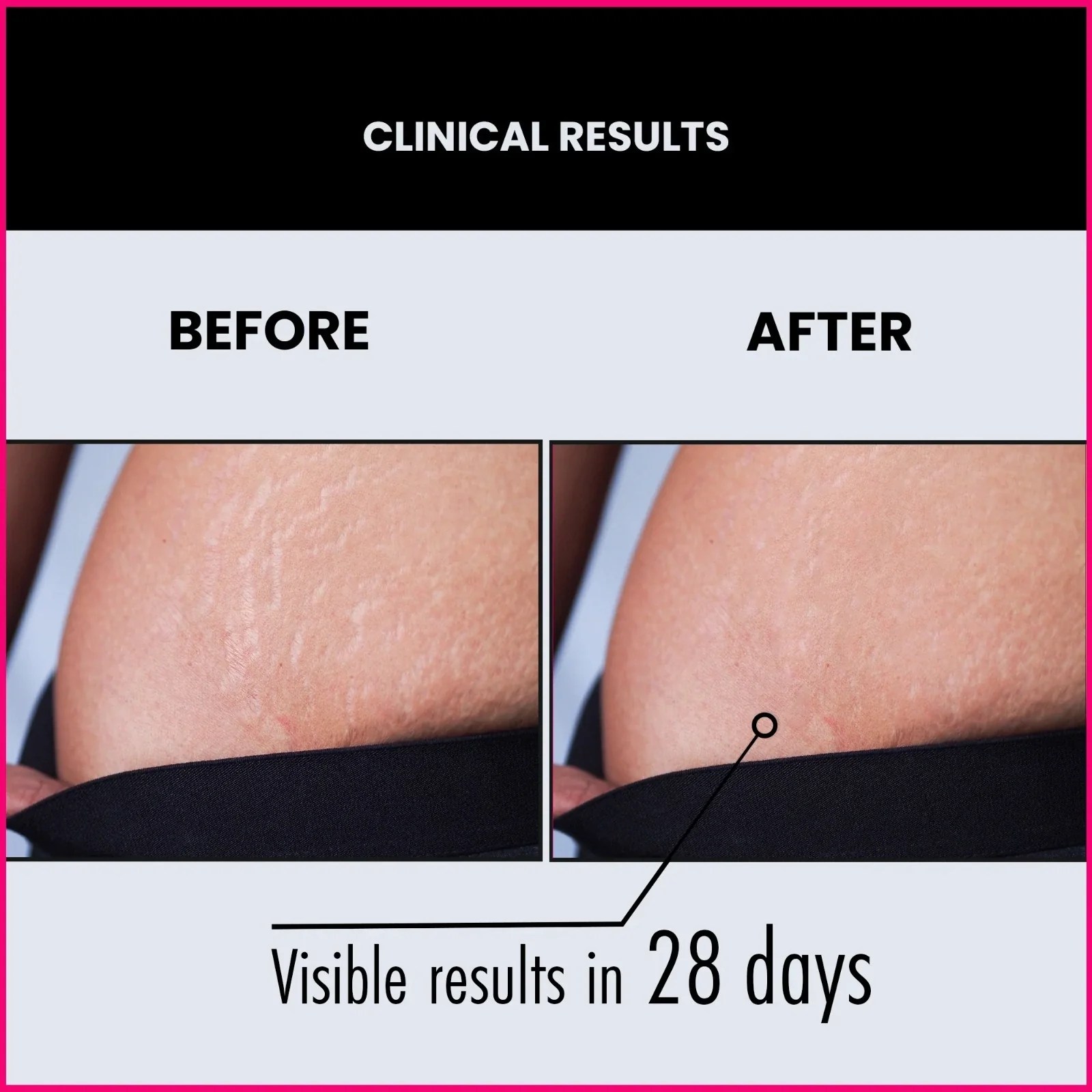 Best Stretch Marks Removal Cream For Women Men Thriveco