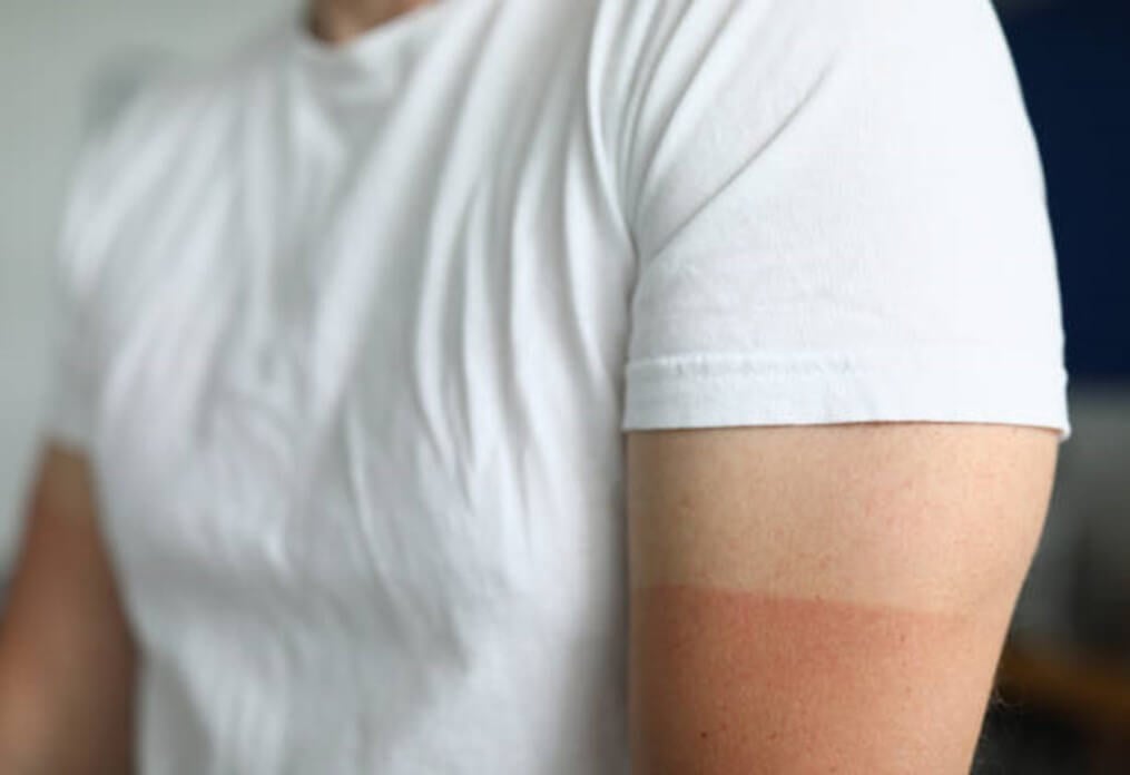 Cara Agar Kulit Tidak Belang, Tak Cukup Pakai Sunscreen