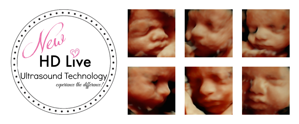 The one where you dread even a polite conversat. 3d Ultrasound Packages Tiny Hearts 3d