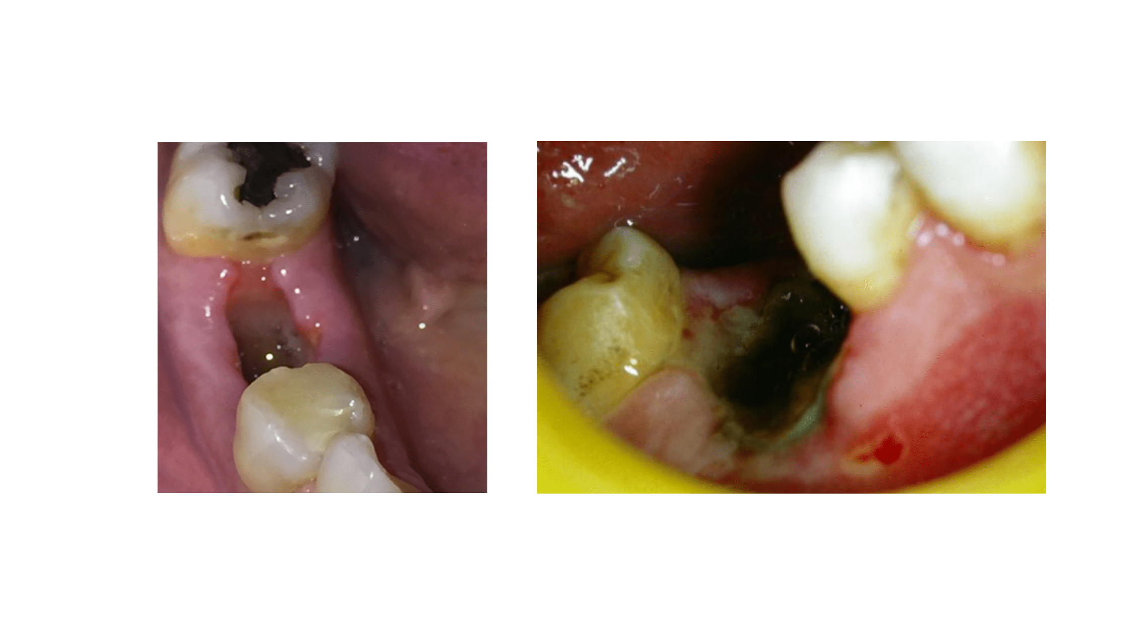 Dry Socket: The Most Common Complication After Tooth Extraction