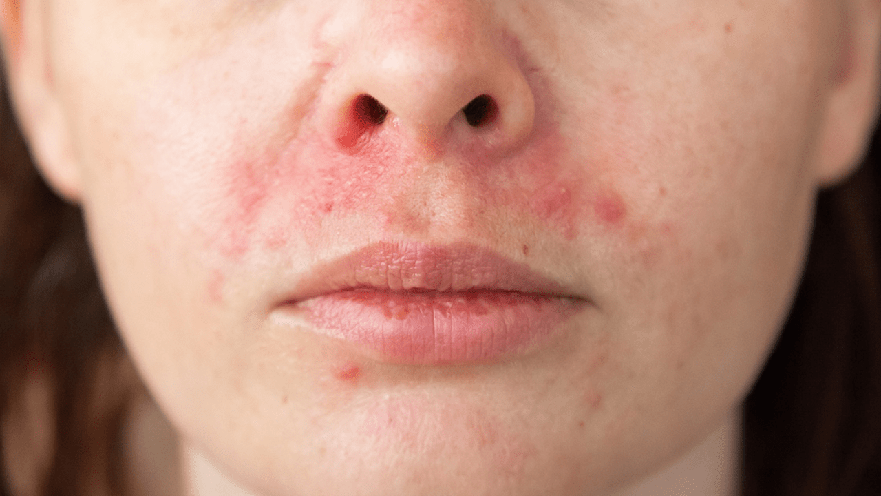 ผื่นแดง เป็นขุย แสบคัน ระวังอาจเป็น 'โรคเซ็บเดิร์ม' ภาวะเรื้อรังที่ทำเสียเซลฟ์