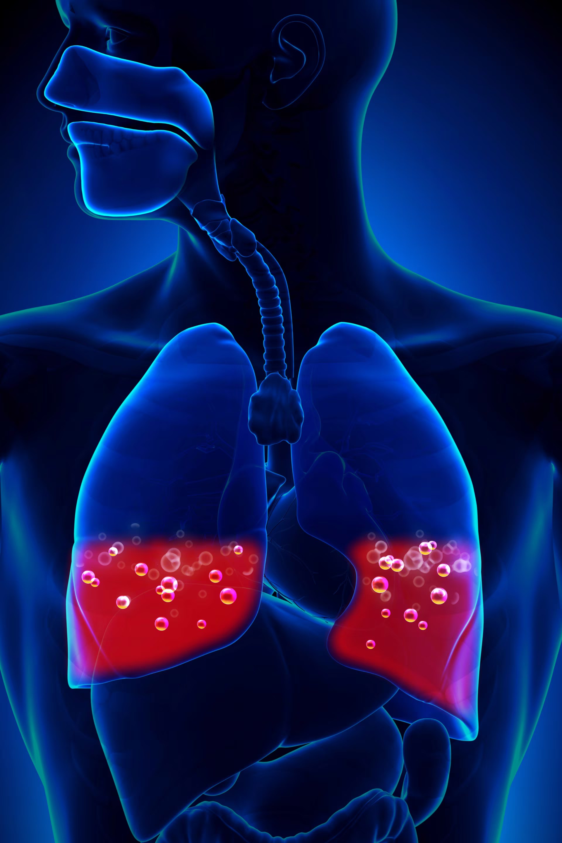 I2690, septic pulmonary embolism without acute cor pulmonale. Pulmonary embolism: which patients should receive
